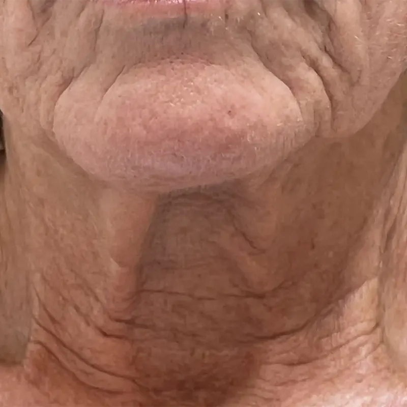 prije tretmana koža